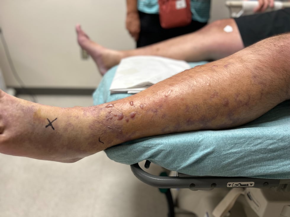 On Saturday morning, Ben West’s family said he got infected with Vibrio Vulnificus after they...