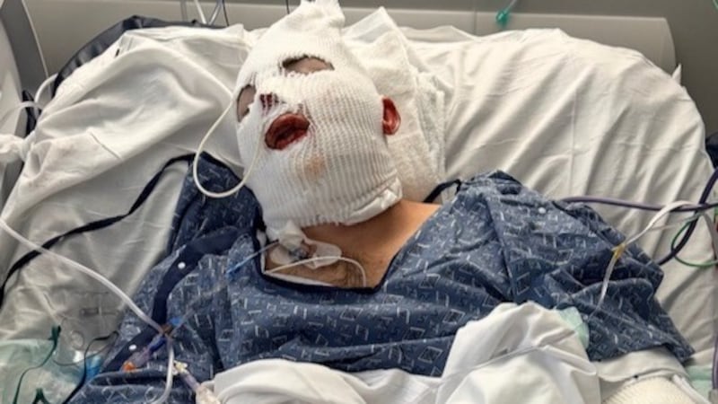 A Mobile man is recovering in the hospital with severe burns after a yard-work fire turned...