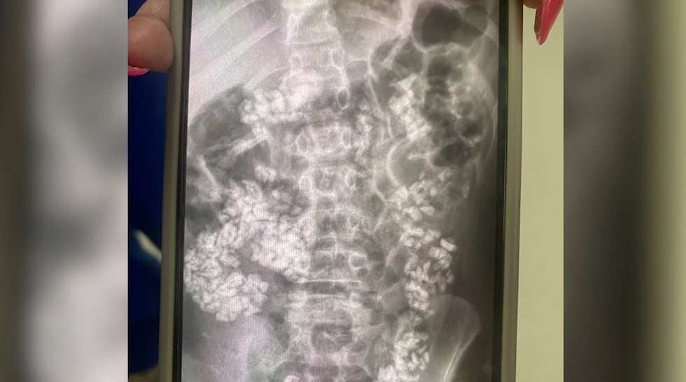 When Candice Whitlow was shown her 9-year-old son’s abdominal X-ray, she says she saw large...